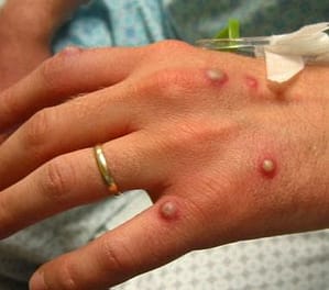 Read more about the article Save Yourself from Monkey Pox: The Disease and How to Prevent it