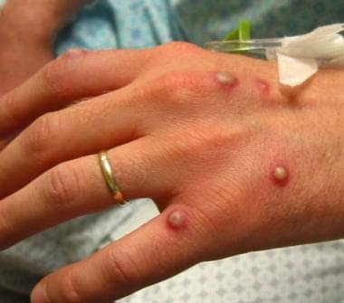 Read more about the article Save Yourself from Monkey Pox: The Disease and How to Prevent it